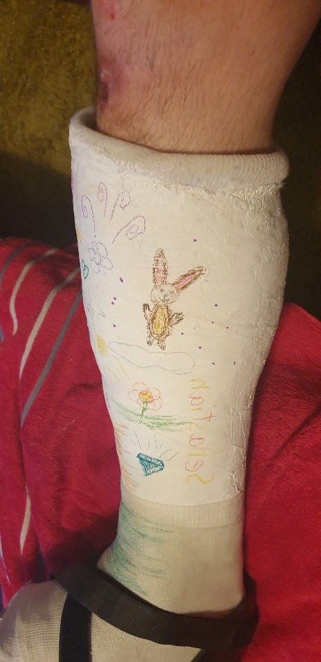 Der Gips von Sebastian Gruber